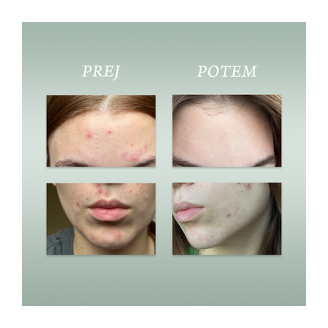 Afrodita PURE SKIN SOLUTION Pattanások elleni koncentrátum spray arcra és testre